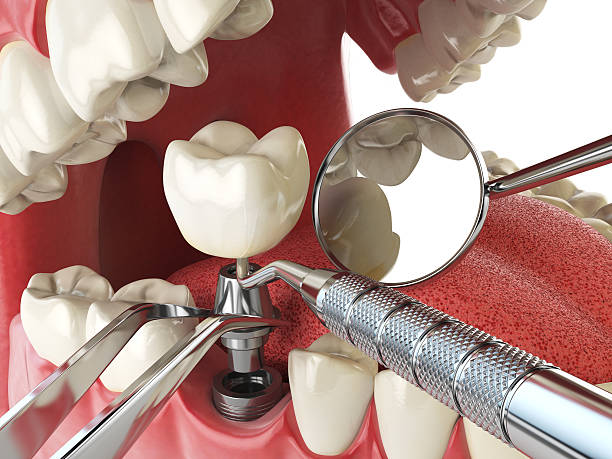 Best Emergency Dental Extractions in Elgin, IL